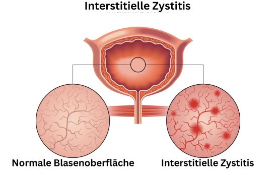 Interstitielle Zystitis